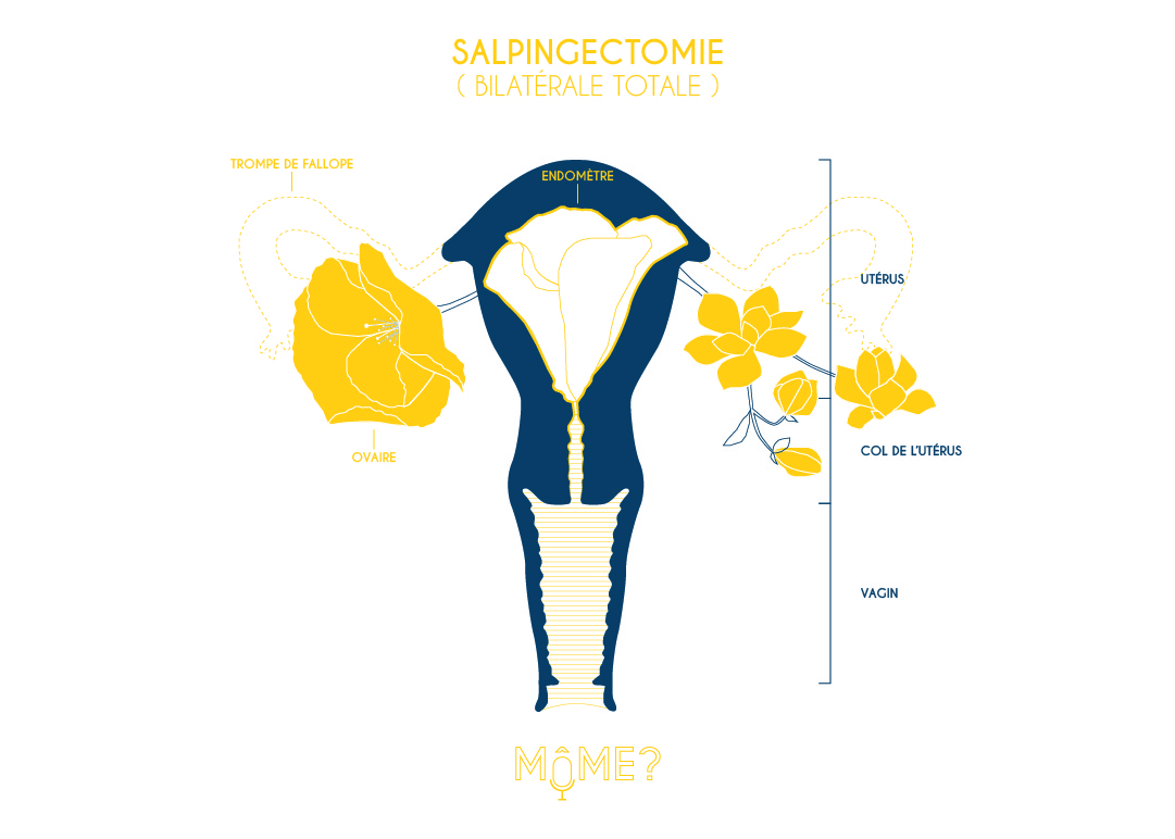 Illustration_sterilisation_salpingectomie